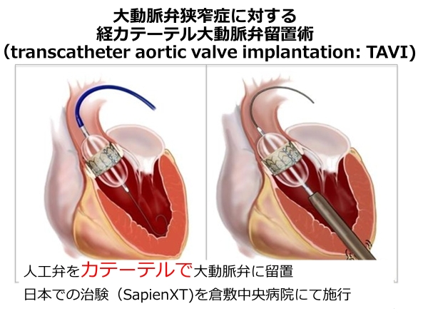 TAVI(経カテーテル的大動脈弁留置術)1