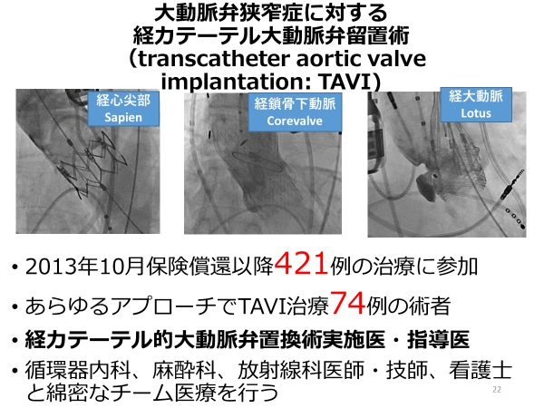 TAVI(経カテーテル的大動脈弁留置術)2