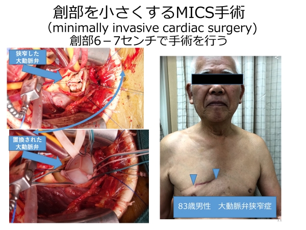 MICS(低侵襲心臓手術)1